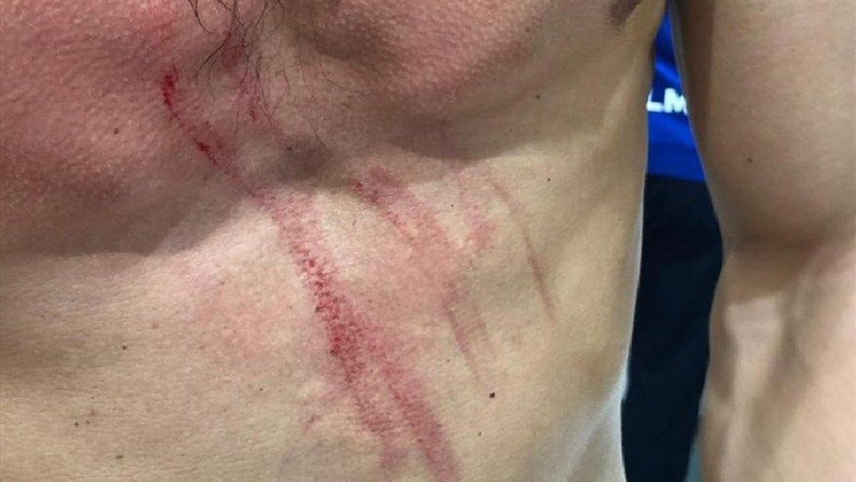 Шунин показал кровавые полосы на груди после матча ...