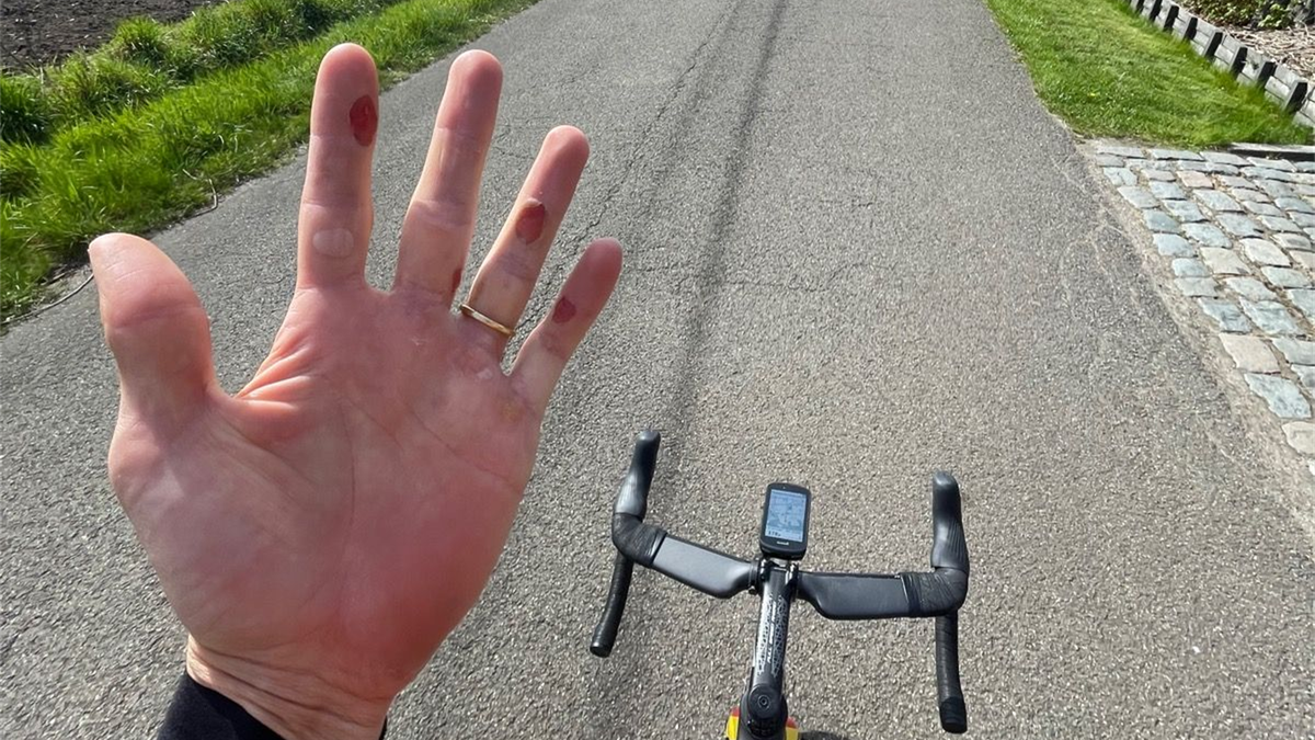 Zo ziet de hand van Van Aert eruit na het rijden van Parijs-Roubaix