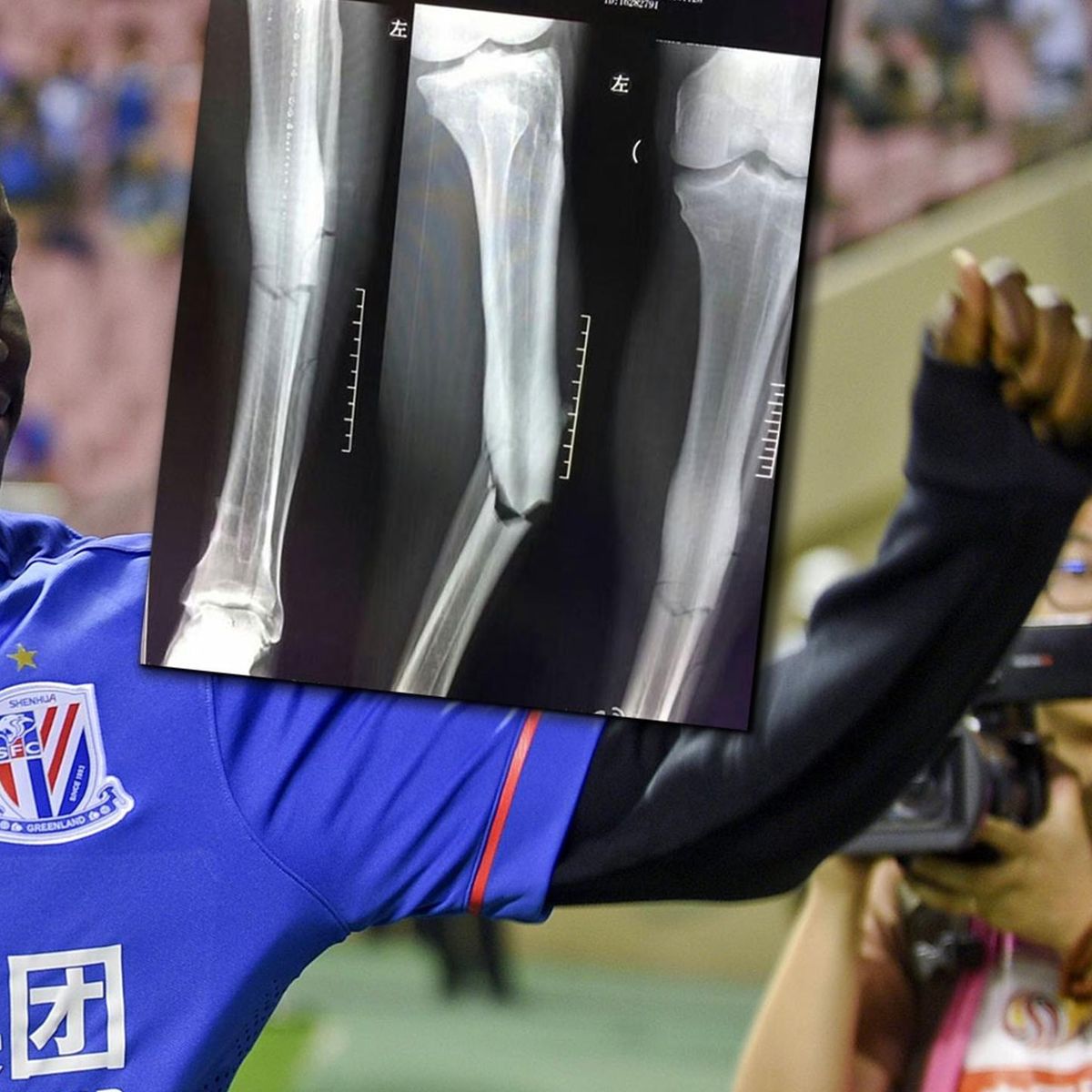 Demba Ba S Horrific Injury X Rays Of Leg Break Hit Social Media Eurosport