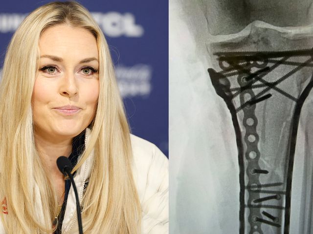 Lindsey Vonn, 6° intervento chirurgico dopo la terribile caduta in ...